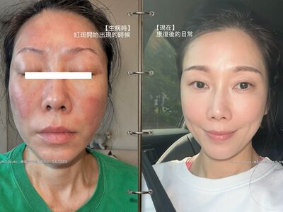 KIMIKO消失近2週驚爆「鬼門關走一遭」 全身紅斑、臉腫變形急送醫