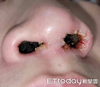 約會前猛拔鼻毛!男大生「流膿結血痂」痛到求救