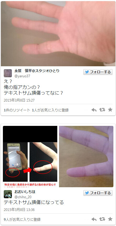 手機太大還是用得太久？日本傳小指變型案例